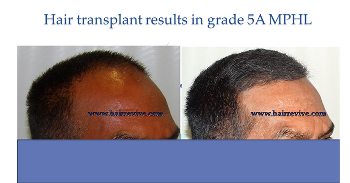Hair Transplant Grade 5A