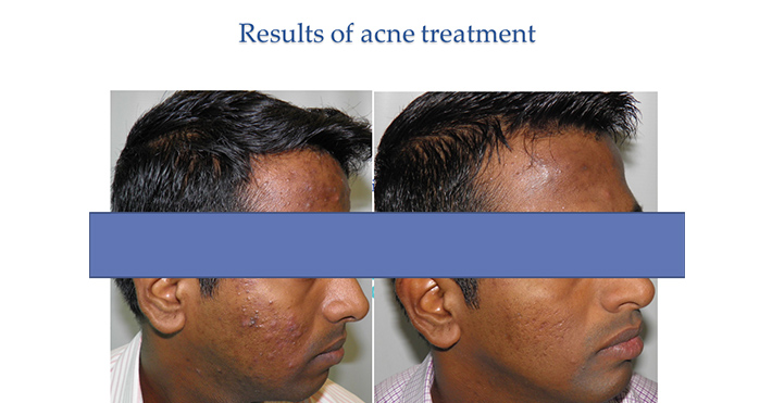 Results of acne treatment