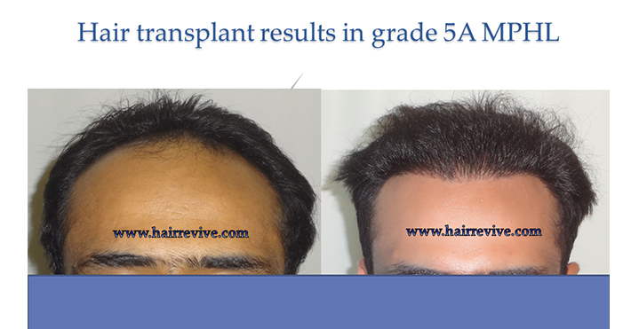 Hair Transplant Grade 5A