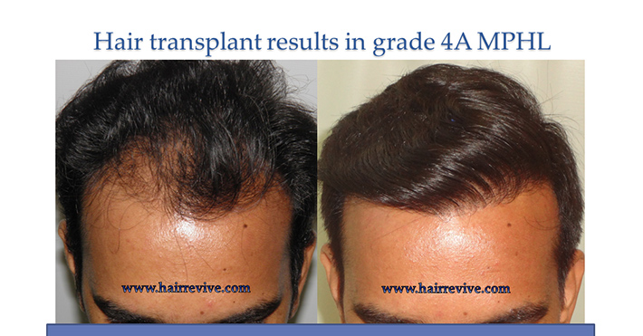Hair Transplant Results in grade 4A