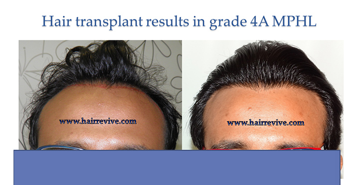 Hair Transplanatation Surgical Results – Hairrevive