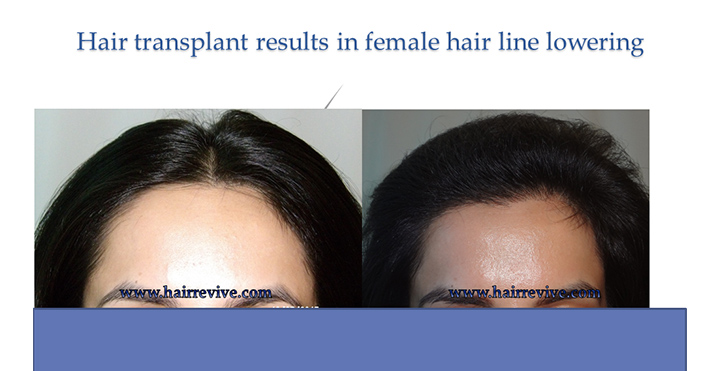 Hair Transplant Results in female