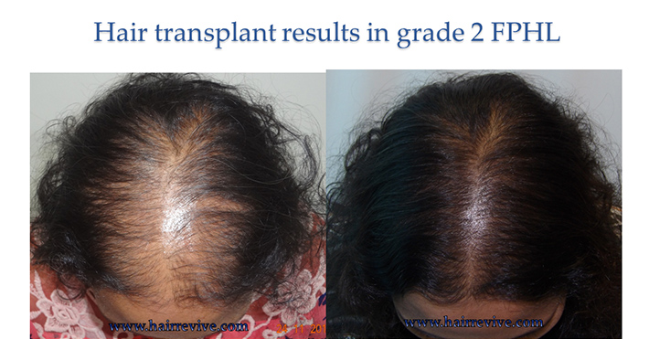 Hair Transplant Results in grade 2