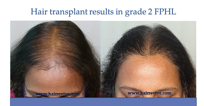 Hair Transplant Results in grade 2
