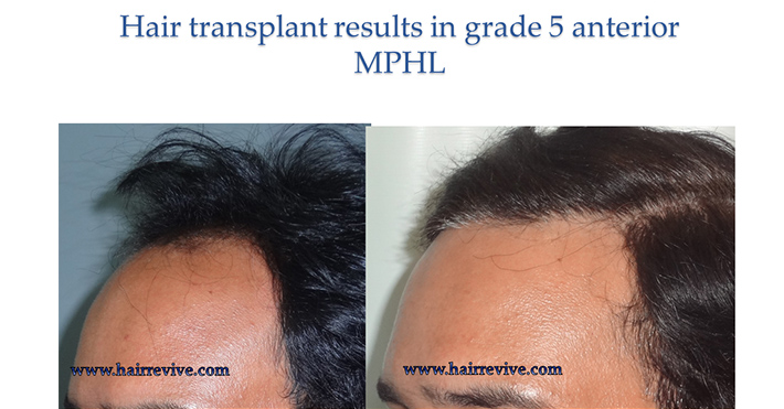 Hair Transplant Results in grade 5