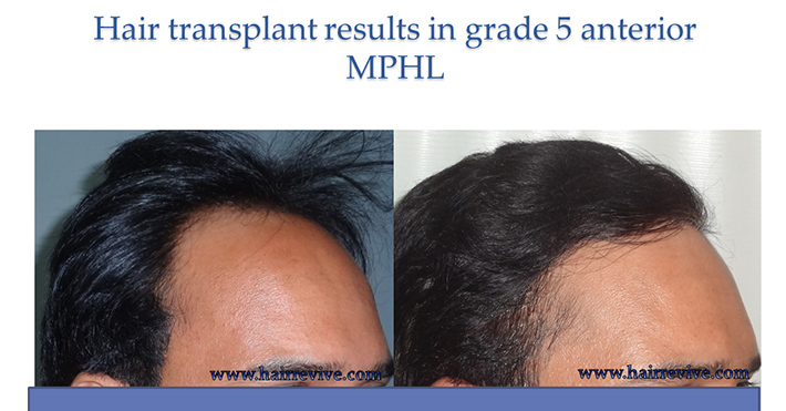 Hair Transplant Results in grade 5